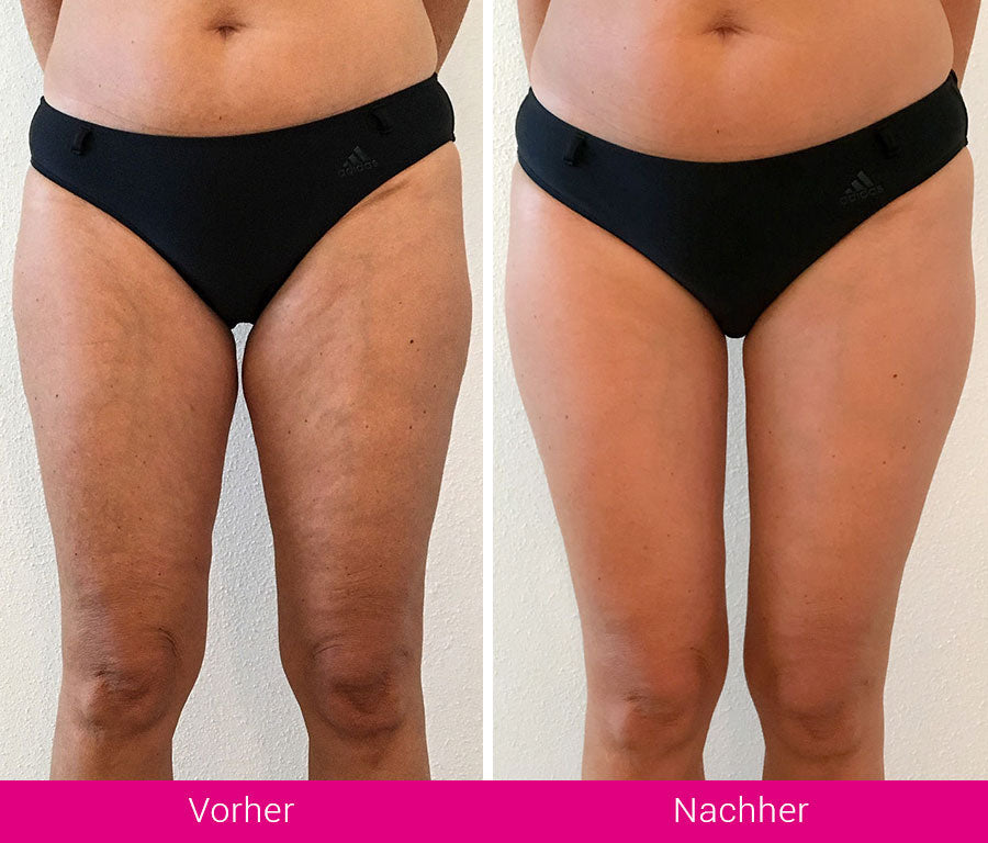 Lush FigurPro - Kompression für mehr Power & Straffung